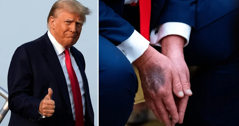 ABD Başkanı Trump elindeki morlukların sebebini açıkladı: Batıl inançlara sahibim Amerika Haberleri