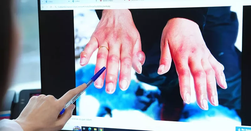 Kış aylarında vakalar artıyor! Soğuk havalarda uzuv kaybına karşı önleminizi alın