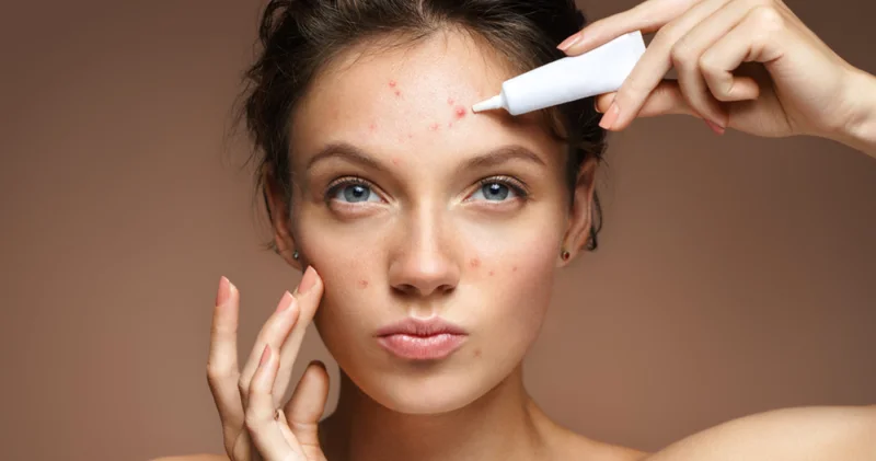 Sivilce döngüsünü kırın: Cilt sağlığını destekleyen beslenme önerileri