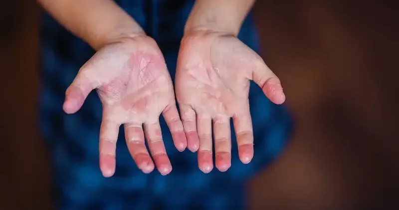 Fabry hastalığında erken tanı için aile taraması önem taşıyor Sağlık Haberleri