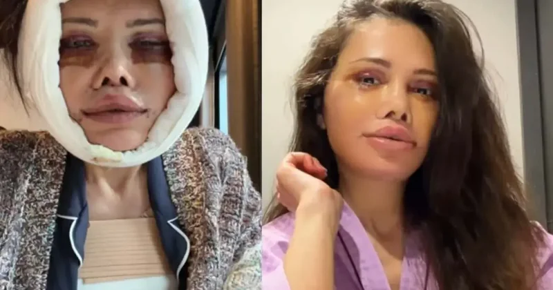Kore de yüz nakli geçirmişti! Didem Ceran ın yüzü ile ilgili sorduğu soru gündem oldu