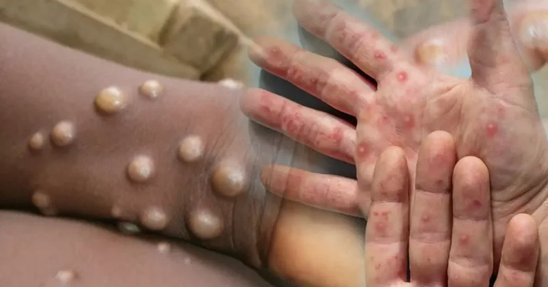 DSÖ den M çiçeği virüsü uyarısı: Salgın kıtayı aştı! Kontrol altına alınmalı