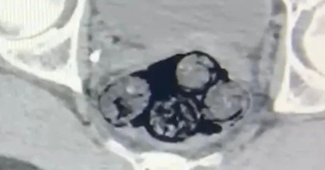 Vücudundaki 140 gram uyuşturucu radyolojik muayeneyle tespit edilen şüpheli tutuklandı Iğdır Haberleri