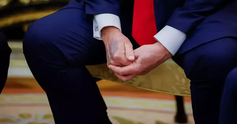 Donald Trump ın elinin o görüntüsü tüm dünyada gündem olmuştu! Sebebini sonunda açıkladı