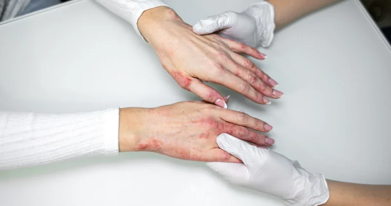 Kışın bu hatalar egzama şikayetlerini artırıyor Sağlık Haberleri