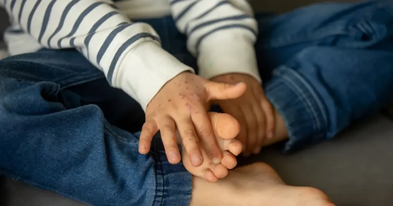 Ateşle başlayıp ağız yaralarıyla devam ediyor! Son dönemde vakalar arttı