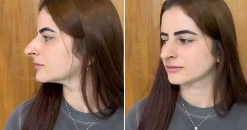 Hevesle burun estetiği oldu ama sonu skandal