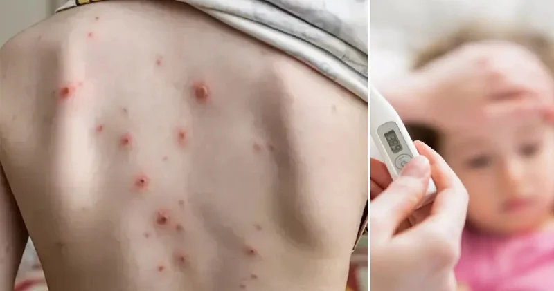 Okullarda suçiçeği vakaları görülmeye başladı Aktüel Haberleri