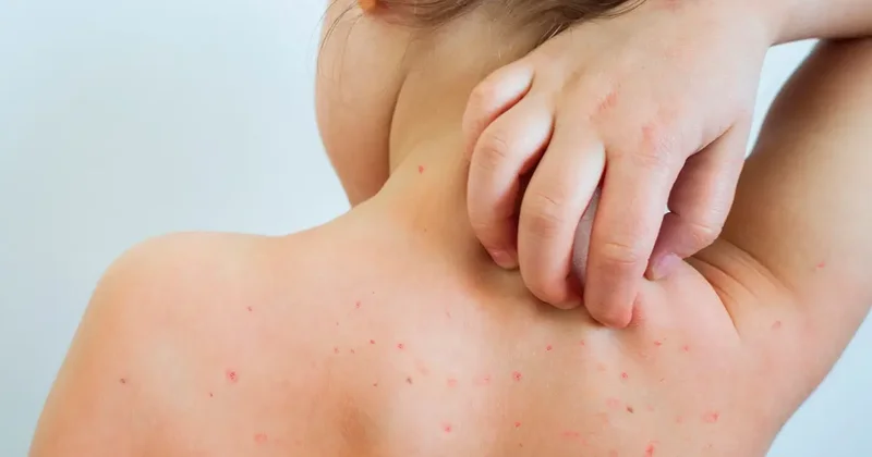 Okullarda suçiçeği alarmı! Veliler tedirgin: Bu belirtiler varsa dikkat