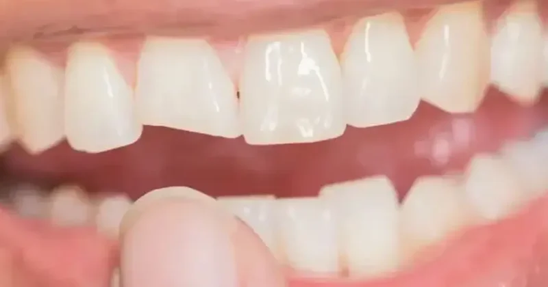 Siz de uzak durun: Dişlerinizi sinsice eritiyor, büyük zarar veriyor!