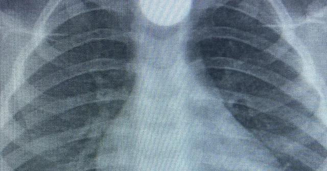 3 yaşındaki Bilal in, yuttuğu 50 kuruş yemek borusunda takıldı Bursa Haberleri