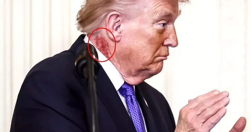 Trump ın boynundaki kızarıklık hakkında doktorundan açıklama
