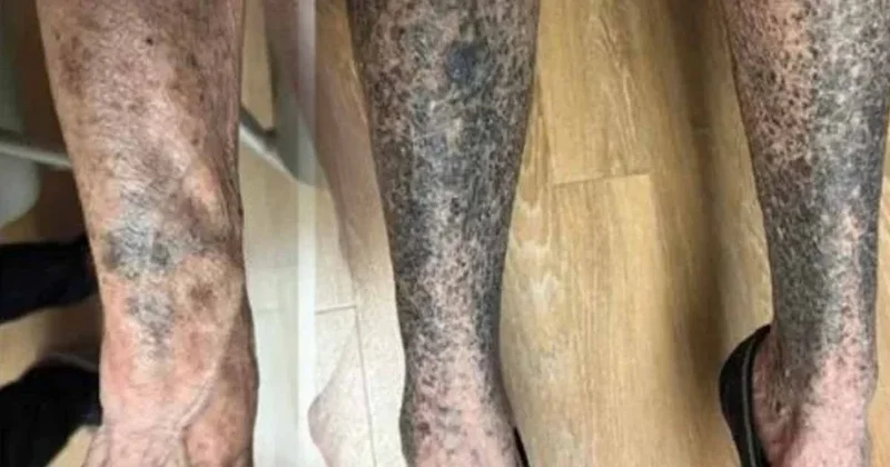 Antibiyotik kullandıktan sadece 14 günde tüm vücudu maviye döndü! Sözcü Gazetesi