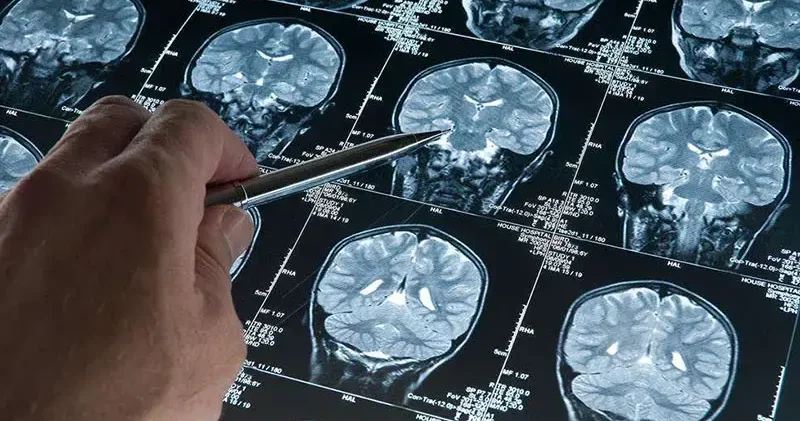 Araştırma: Alzheimer düşünüldüğünden daha erken başlayabilir