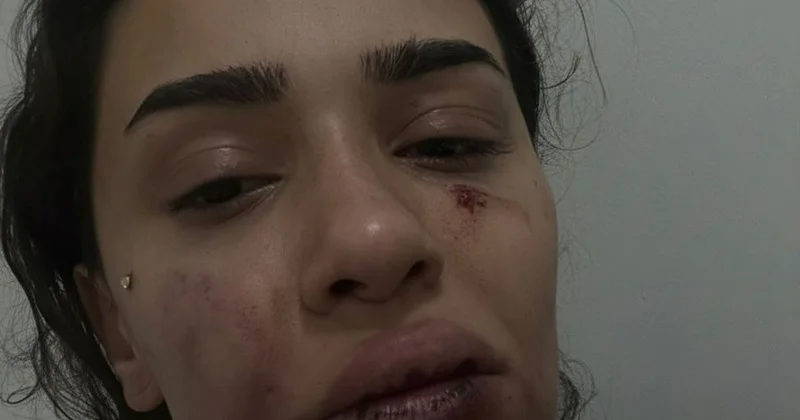 Hemşire Ebru Anik: Uzaklaştırma Kararına Rağmen Eski Sevgili Şiddeti
