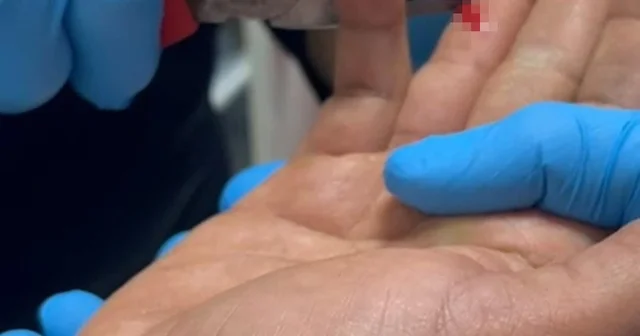 Balık macerası hastanede bitti: Parmağına saplanan olta iğnesini itfaiye çıkarttı Adıyaman Haberleri