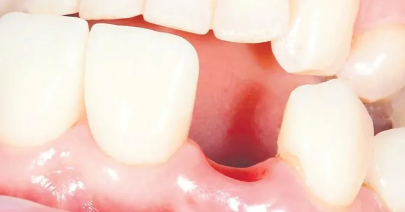 Diş kaybı hafıza zayıflatıyor