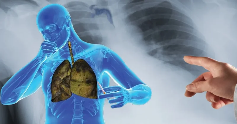 Her Yıl 2 Milyona Yakın İnsan Bu Hastalık Nedeniyle Hayatını Kaybediyor