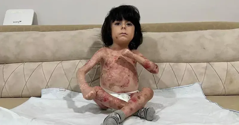 4 yaşındaki İbrahim, Kelebek hastalığı nedeniyle kıyafet giyemiyor