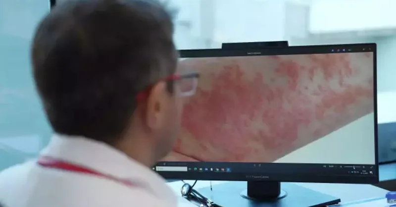 Uzmanından uyarı: Egzamalı çocuğa ezbere diyet yaptırmayın