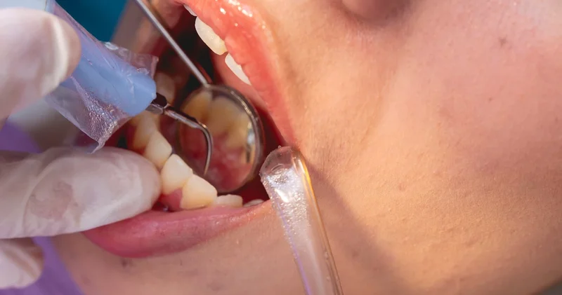 Dişçiye para vermeden kurtulmak aslında mümkünmüş! İşte diş taşlarını gidermeye yardımcı olan doğal yöntemler