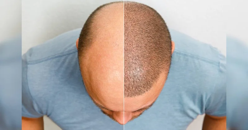 İstanbul da turistlere saç ekimi yapan sahte doktor skandalı!