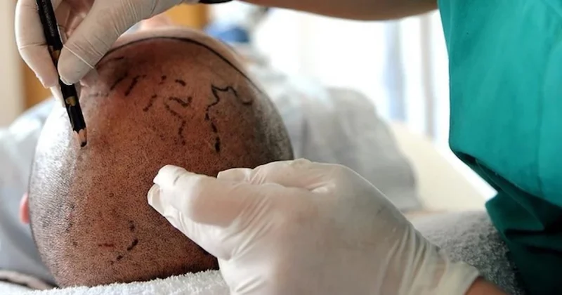 Saç ekim uzmanı bakın kim çıktı! Milli futbolcumuza bile saç ekmiş, şimdi hapse girecek Sözcü Gazetesi