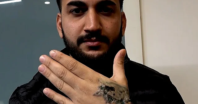 Dövme sildirdi kabusu yaşadı: Deri naklinden başka çaresi kalmadı VİDEO İZLE