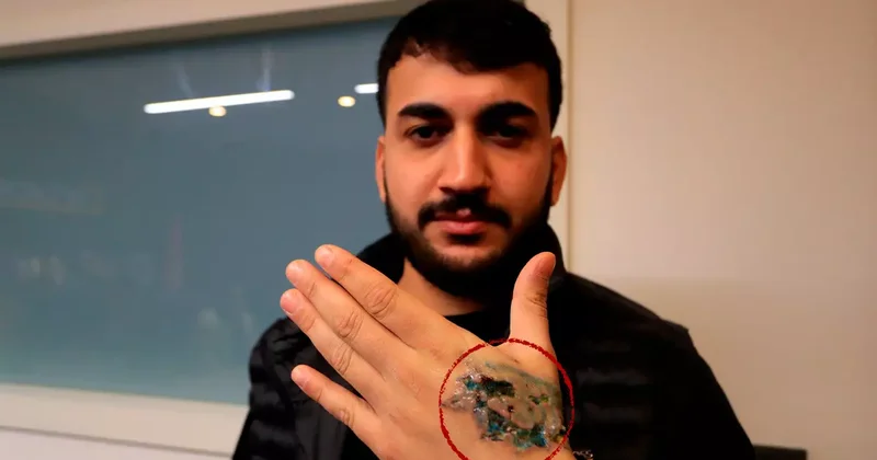 Dövme sildirmek için güzellik merkezine gitti, elini kaybediyordu!