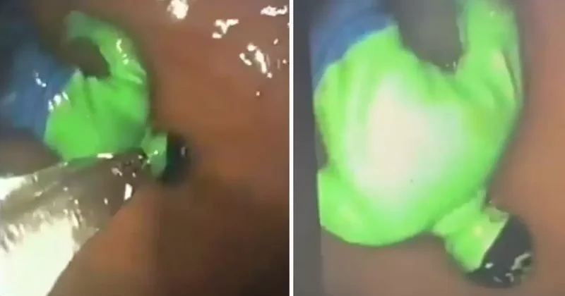 Hindistan da çocuğun midesinden hulk çıktı