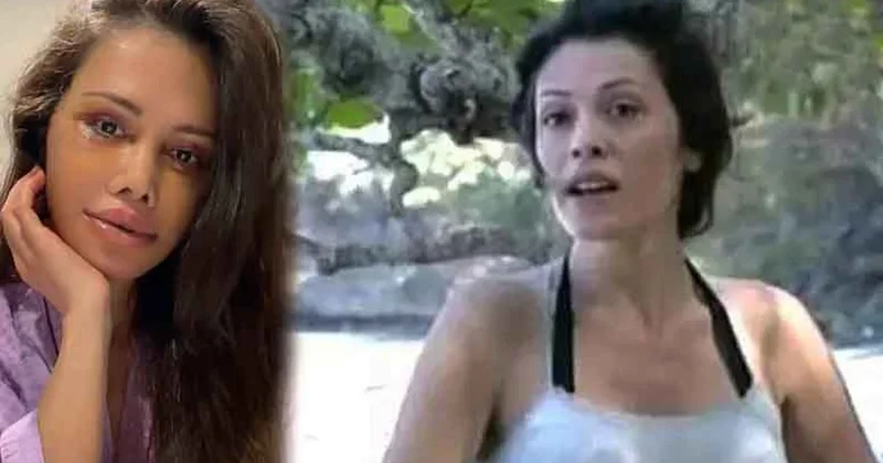 Survivor ın eski yarışmacısı Didem Ceran yüz nakli operasyonu geçirdi Sözcü Gazetesi