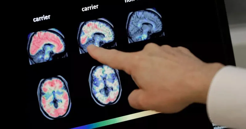 Bilim insanları Yüzde 99 öldürüyor diyerek açıkladı! Burundan bulaşan virüs beyni mahvediyor Sözcü Gazetesi