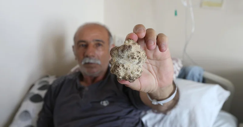 Doktorları şaşırttı: Elma büyüklüğünde taş çıktı