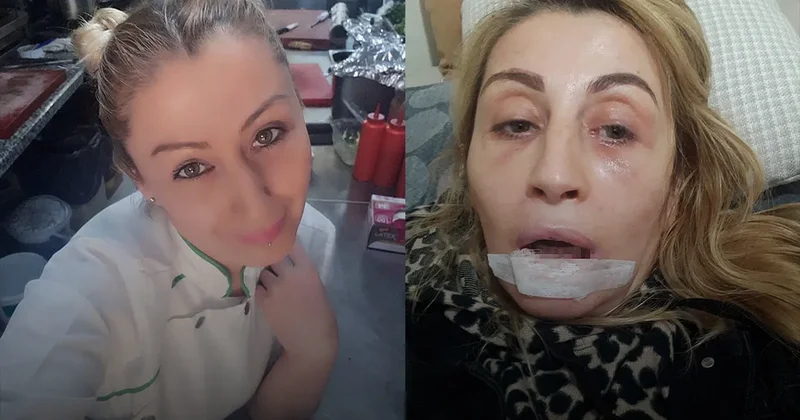Antalya da estetik faciası: İşlem sonrası dudağı çürüdü! Gülüşüm yok