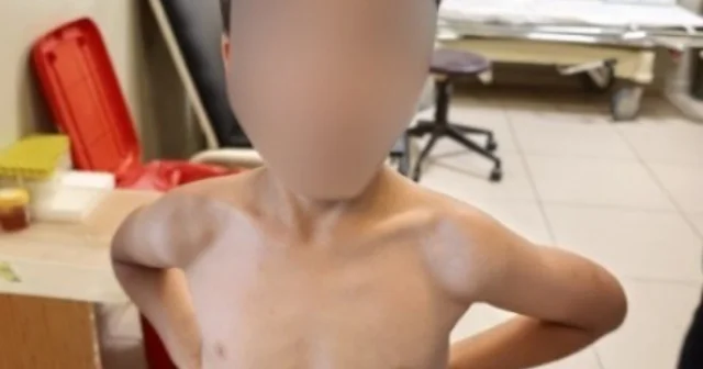 İnegöl de kene alarmı 7 yaşındaki çocuğun göğsüne kene yapıştı Bursa Haberleri Habertürk Yerel Haberler