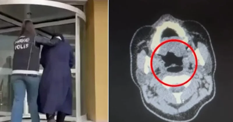 Yer: Kayseri... 27 yaşındaki kadının midesinden çıkanlar polisi şoke etti Sözcü Gazetesi