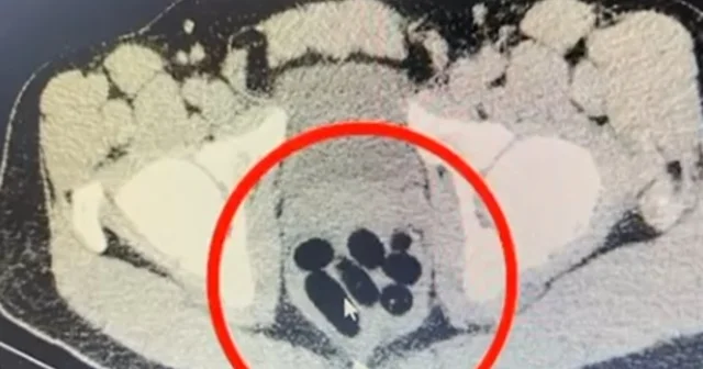 Midesinden yarım kilo metamfetamin çıktı Kayseri Haberleri