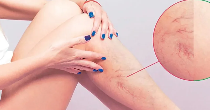 Varis vücutta ‘Pıhtı’ riskini artırabilir Sözcü Gazetesi