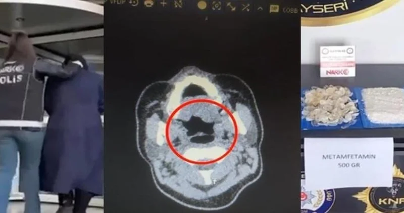 Doktorlar bile inanamadı: Midesinden tam 500 gram metamfetamin çıktı