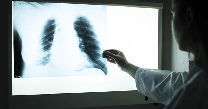 Üç haftayı aşan öksürük ve kilo kaybı tüberküloz belirtisi olabilir Sağlık Haberleri