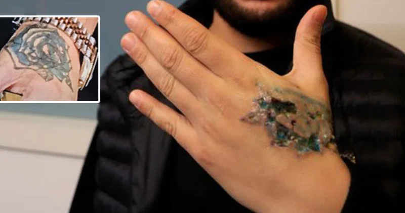 KORKUNÇ OLAY! Dövmesini sildirecekti kâbusu yaşadı SON DAKİKA HABERİ Son dakika haberleri