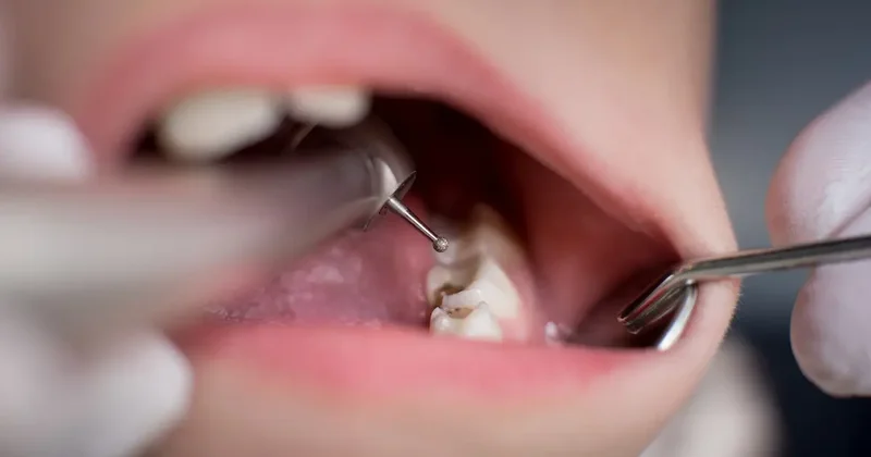 Dişlerinize içten içe zarar veriyor! İşte 3 tehlikeli belirti