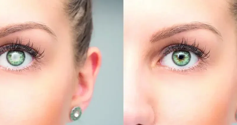 Genç gözlerde katarakt artıyor Sağlık Haberleri