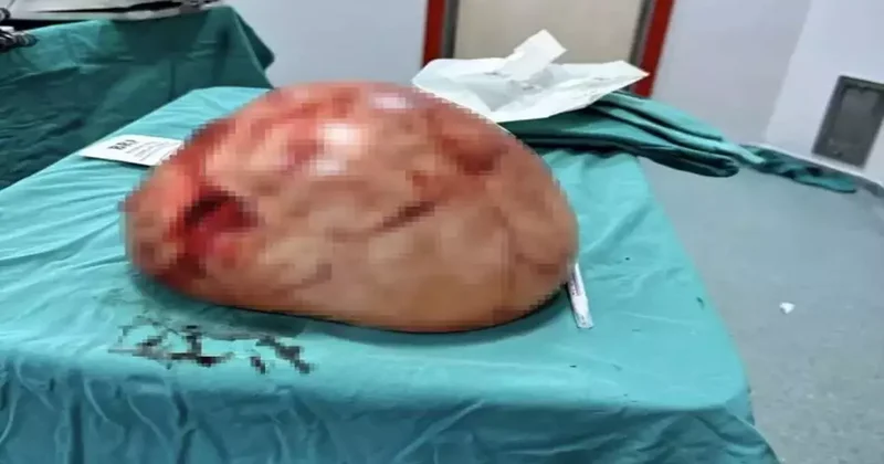 Van da tıp dünyasını şaşırtan operasyon: Karnından 35 santimetrelik kitle çıktı