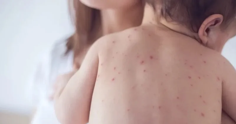 Bangladeş te kızamık yayılıyor: 7 bin vaka, yüzlerce çocuk hayatını kaybetti