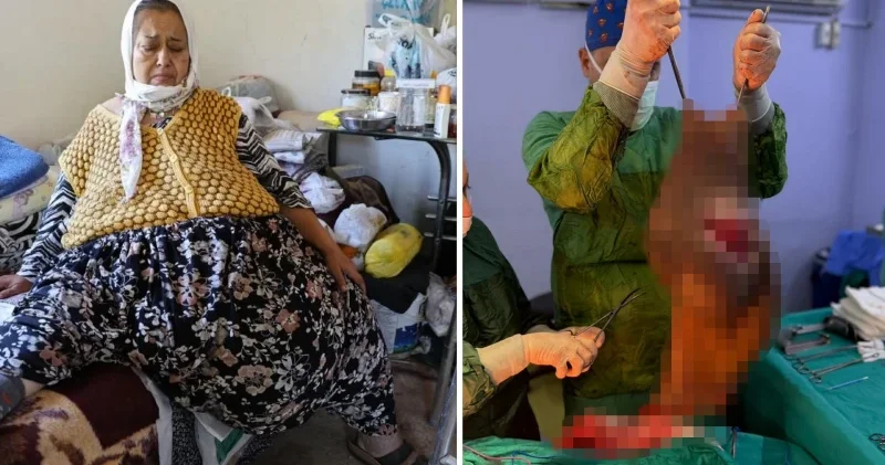 Bağ evinde yaşayan kadım 170 kiloya ulaştı: Karnında 40 kiloluk kitle varmış Aydın Haberleri