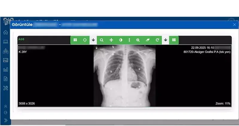 Sağlık Bakanlığı, Akciğer Görüntüleme Sistemi ni hayata geçirdi