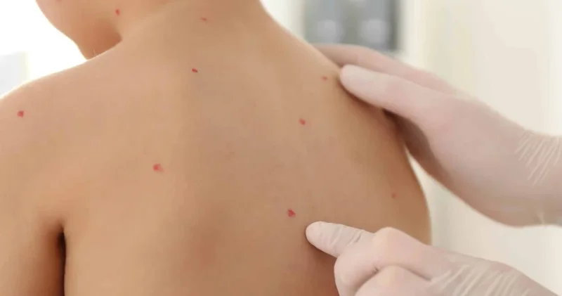 Aileler dikkat: Okul ve kreşlerde yayılan suçiçeği riskine karşı uzmanlar uyardı Sağlık Haberleri