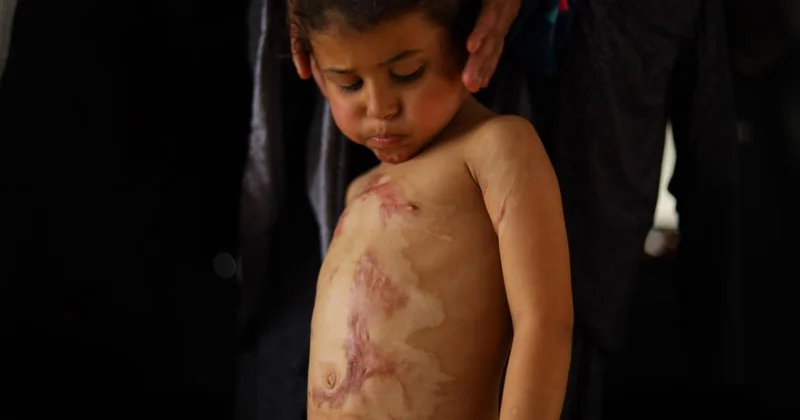 Katil İsrail in kısıtlamaları nedeniyle Gazze de yanık hastaları için tıbbi malzemeler tükenmek üzere