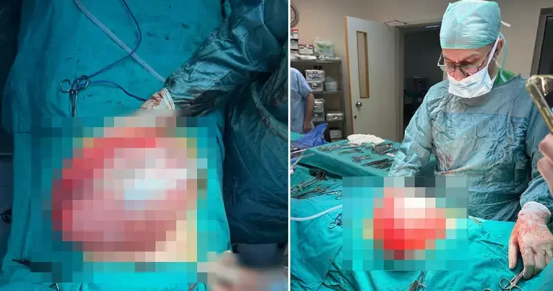 Kilolarından kurtulmak için doktora giden liseli kızın karnından 3,5 kilo ağırlığında kist çıktı